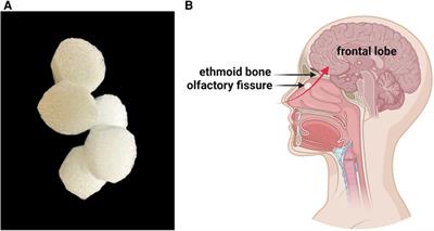 Providing holistic care to children with cerebral palsy treated with transnasal neural stem cell transplantation